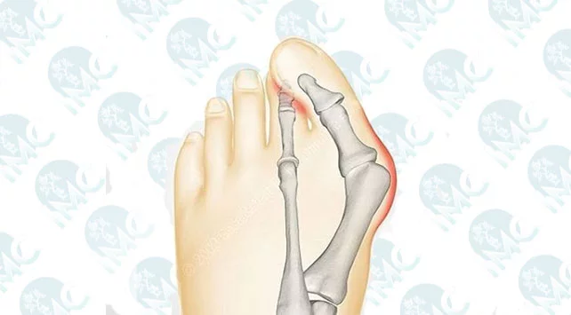 Hallux Valgus